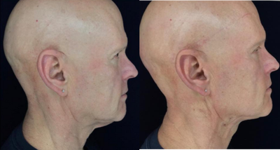 Skin Tightening before and after photo