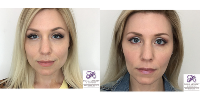 Cheek Fillers before and after photo