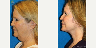 Facial Fat Transfer before and after photo
