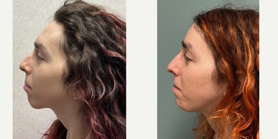 Facial Feminization Surgery before and after photo