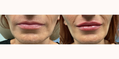 Lip Fillers before and after photo
