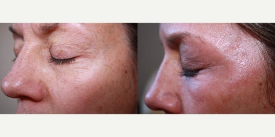 MiXto Laser before and after photo