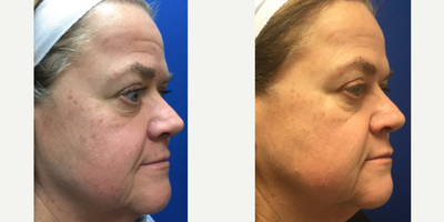 Botox before and after photo