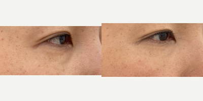 Dermal Fillers before and after photo