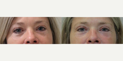 Eyelid Surgery before and after photo
