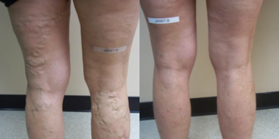 Sclerotherapy before and after photo