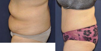 Tummy Tuck before and after photo