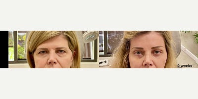 Brow Lift before and after photo