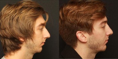 Chin Implant before and after photo