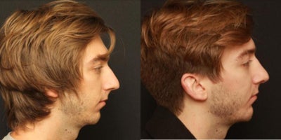 Chin Implant before and after photo