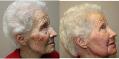 Laser Resurfacing before and after photo