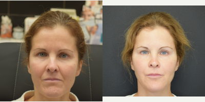 Nonsurgical Facelift before and after photo