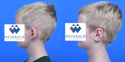 Ear Surgery before and after photo