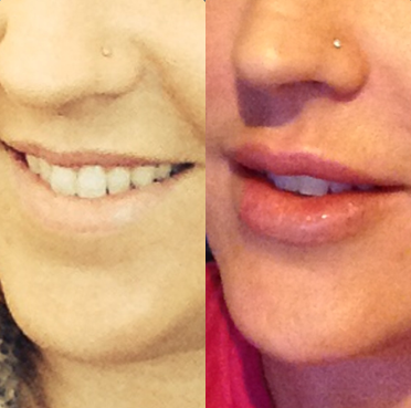 Restylane before and after photo