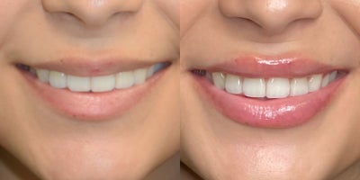 Revanesse before and after photo