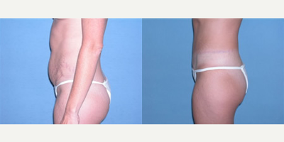 Tummy Tuck before and after photo