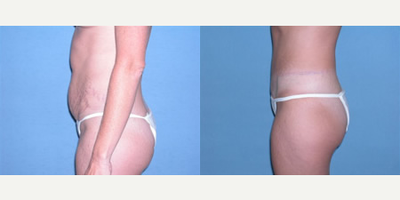 Tummy Tuck before and after photo
