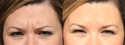 Botox before and after photo