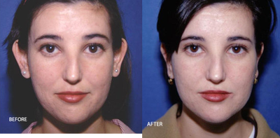 Ear Surgery before and after photo