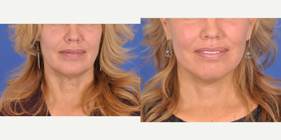Facelift before and after photo