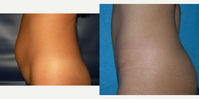 Tummy Tuck before and after photo