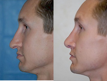 Asian Rhinoplasty before and after photo