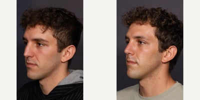 Septoplasty before and after photo