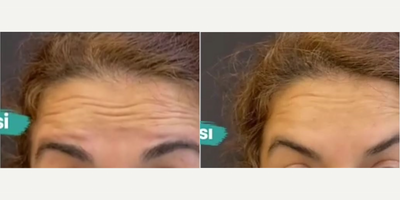 Botox before and after photo