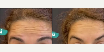 Botox before and after photo