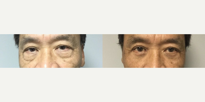 Eyelid Surgery before and after photo