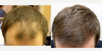 Hair Loss Treatment before and after photo