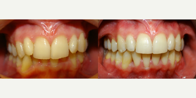 Invisalign before and after photo