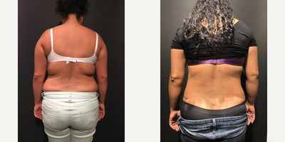 Liposuction before and after photo