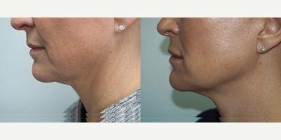 Nonsurgical Facelift before and after photo