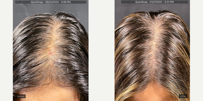 PRP for Hair Loss before and after photo
