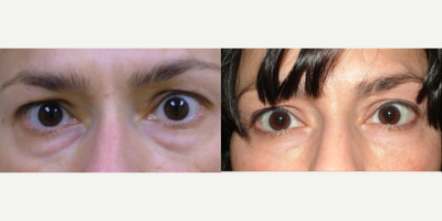 Restylane before and after photo