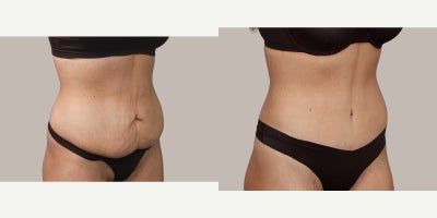 Tummy Tuck before and after photo