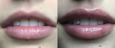 Juvederm before and after photo