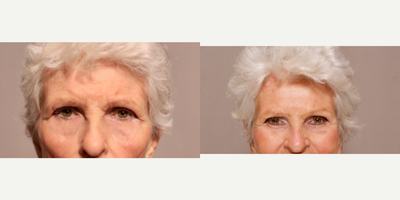 Ptosis Surgery before and after photo