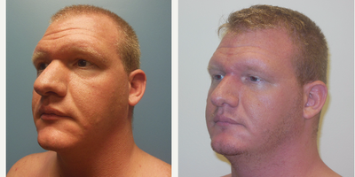 Rhinoplasty before and after photo