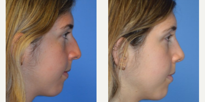 Rhinoplasty before and after photo