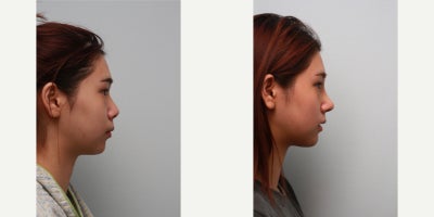 Chin Implant before and after photo
