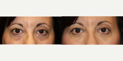 Dermal Fillers before and after photo