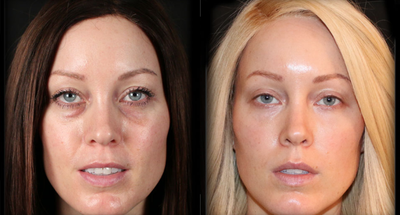 Dermal Fillers before and after photo