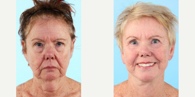 Facelift before and after photo