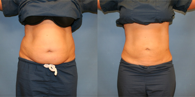 Vaser Liposuction before and after photo
