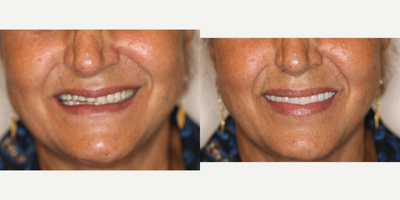 All-on-4 Dental Implants before and after photo