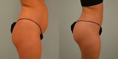 Brazilian Butt Lift before and after photo
