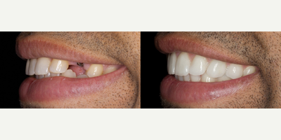 Dental Implants before and after photo