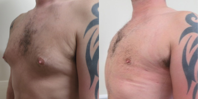 Gynecomastia Surgery before and after photo